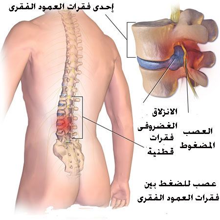 آلام العمود الفقري